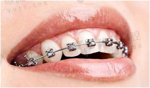 牙片怎么区分左右（牙片神*线怎么看）(图1)
